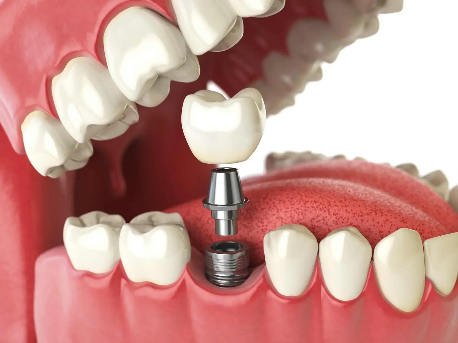 3D model of a dental implant with screw, abutment, and crown being fitted into the lower jaw.